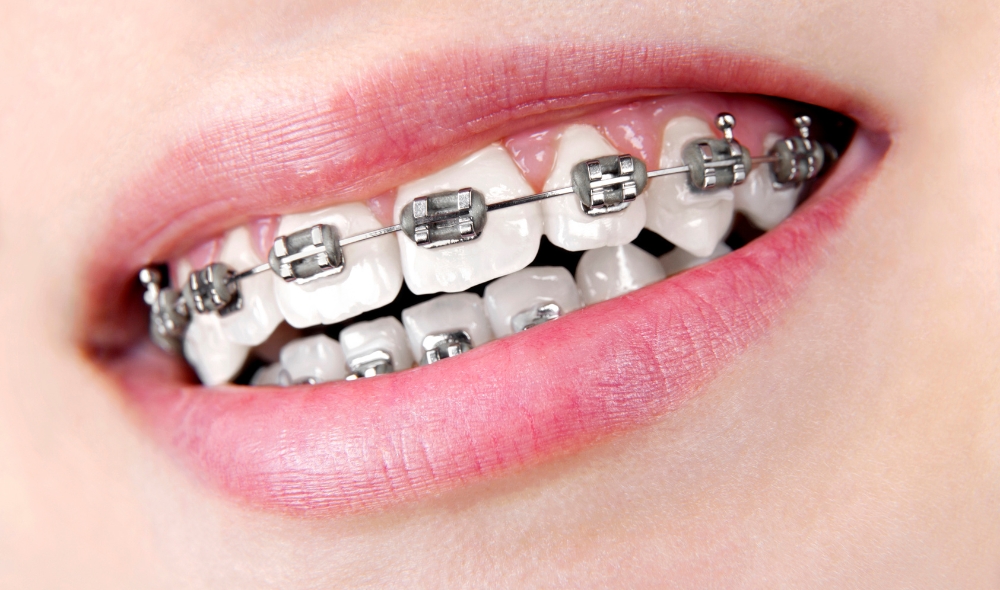 How Do Celebrities Fix Their Teeth Without Braces