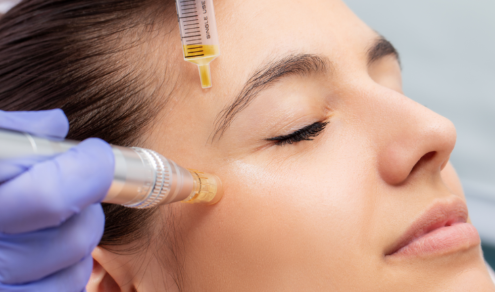 PRP Microneedling Treatment